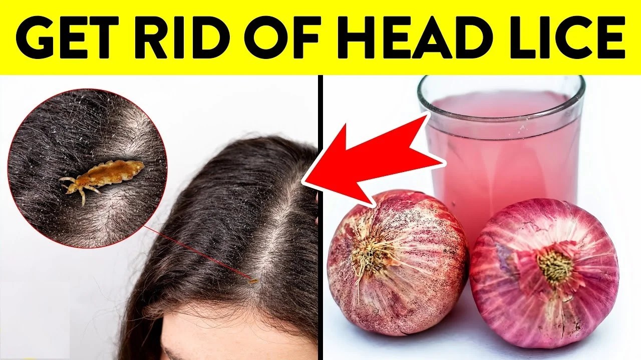 Can Onions Kill Hair Lice